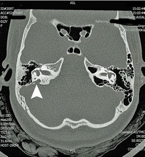 symptoms of enlarged vestibular aqueduct